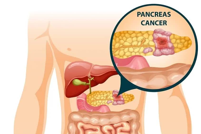Borderline Resectable Pancreatic Cancer